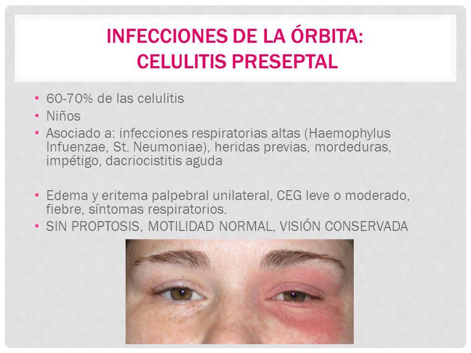impétigo edema periorbitario